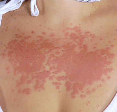 What Are the Signs of an Allergic Reaction to Sunscreen?