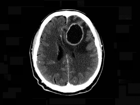 CT vyeten mozku